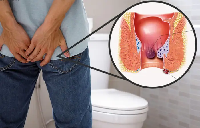piles-treatment
